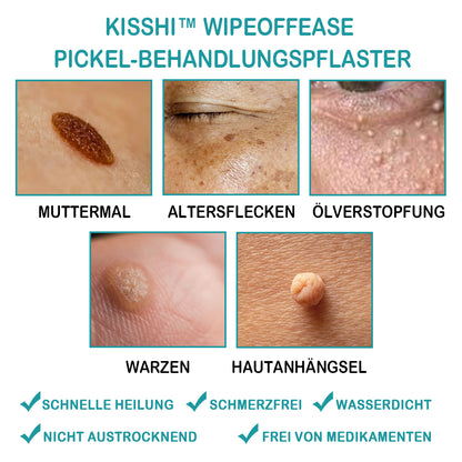 KISSHI™ WipeOffEase Pickel-Behandlungspflaster 🫧