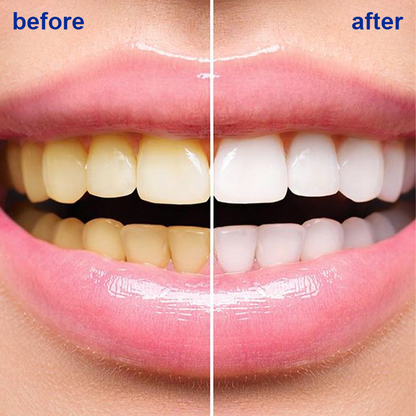 LIMETOW™ Teeth Whitening Powder-HM2