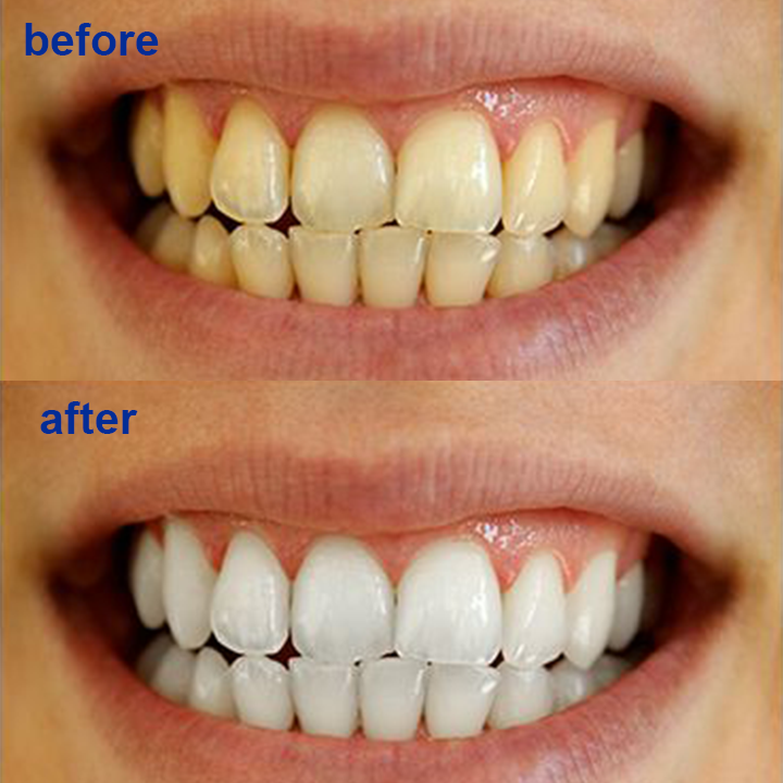 LIMETOW™ Teeth Whitening Powder-HM2