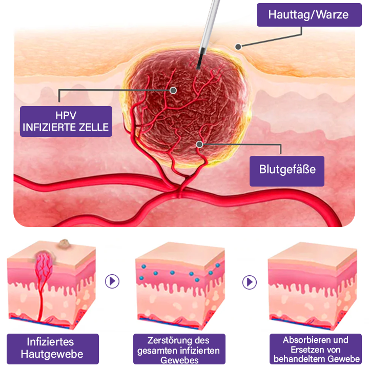 Oveallgo™ AraneaCare Hautfleckenentferner 💧