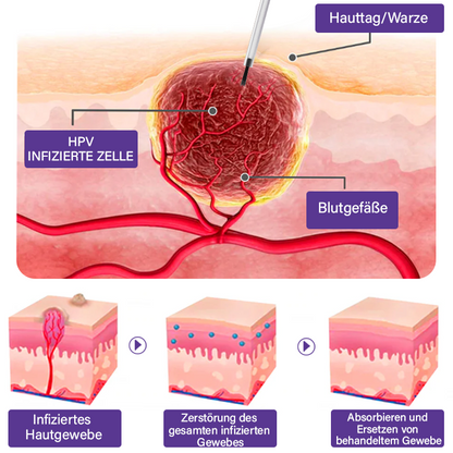 Oveallgo™ AraneaCare Hautfleckenentferner 💧